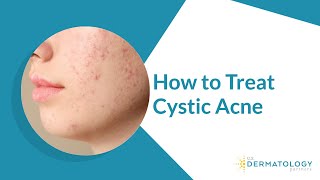 How to Treat Cystic Acne [upl. by Abie679]