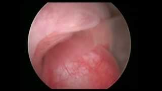 endocervical polyp [upl. by Lehsreh]