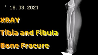 Xray  Tibia and Fibula xray update [upl. by Collins]