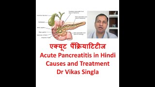 Acute Pancreatitis Treatment and Causes in Hindi By Dr Vikas Singla Max Hospital New Delhi [upl. by Yornoc]