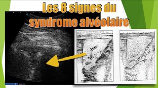 8 aspects de pneumopathie en échographie [upl. by Stringer]