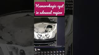 adnexal cyst  cyst on adnexal region  hemorrhagic cyst in adnexal region [upl. by Acul]