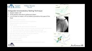 Humeral shaft fractures  2 of 4 [upl. by Yrtnahc]