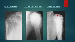 Osteosarcoma x ray appearance [upl. by Inwat82]