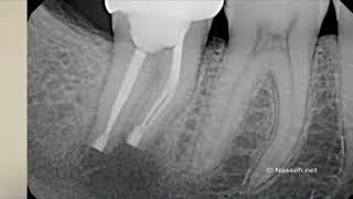 Reimplante Intencional  ENDODONCIA AVANZADA [upl. by Spark742]