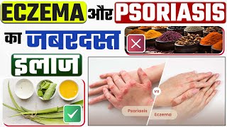 सोरायसिस और एक्जिमा को ठीक करने का जबरदस्त तरीका  Eczema Psoriasis Difference  Eczema ka ilaj [upl. by Tootsie]