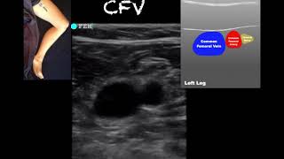 POCUS  Lower Extremity Deep Venous Thrombosis DVT  Updated [upl. by Trammel408]