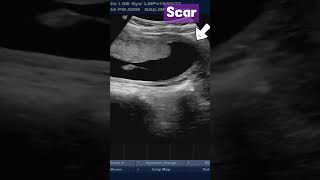 Normal Placenta  in Patient with Previous CSection pregnancy placenta ultrasound baby [upl. by Asante]