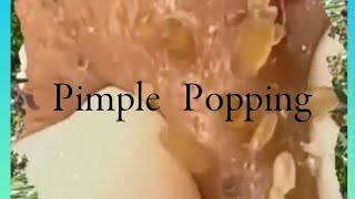 Pimple amp Blackheads Popping  38 [upl. by Milore534]