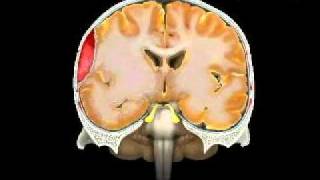 Hematoma Epidural Epidural Hematoma [upl. by Devy277]