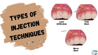 Types of Injections used in Dentistry  Local Anesthesia [upl. by Nywles]