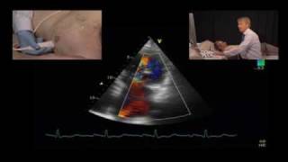 Jet Direction and the Mechanism of Mitral Regurgitation [upl. by Mcallister]