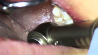 Removing small cavities [upl. by Ahael]