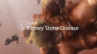 The Urology Group Lithotripsy for Kidney Stones [upl. by Mcleroy887]