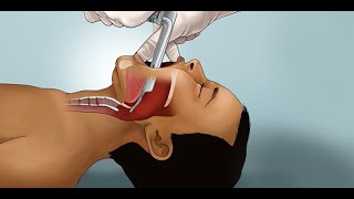 Pediatric Endotracheal Intubation by J Nagler et al  OPENPediatrics [upl. by Watkins]