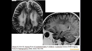 49 Metachromatic leukodystrophy MLD arylsulfatase A deficiency lysosomal tigroid pattern [upl. by Zobkiw988]