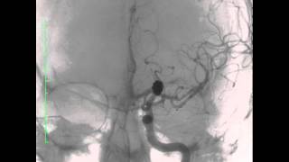 rotational angiographymov [upl. by Oremor]