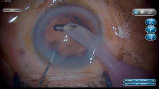 Dr Sourabh Patwardhan Live Cataract surgery For training and consultation call 7028402375 [upl. by Backer]