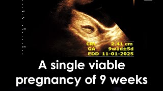 A single viable pregnancy of 9 weeks  Early pregnancy  Practical case [upl. by Gamin]