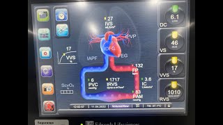 EVEMIL monitorização hemodinâmica invasiva em UTI tempo real de Débito cardíaco [upl. by Scevo]