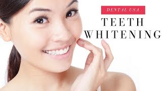 Teeth Whitening Home Remedies [upl. by Kassel]