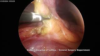 Epiploic Appendagitis [upl. by Brigham856]