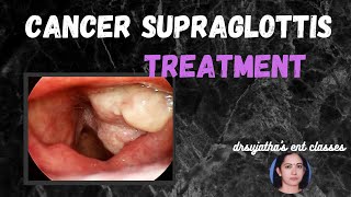 101Treatment of Cancer Larynx Carcinoma Supraglottis larynx treatment laryngoscope [upl. by Yednil105]