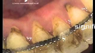 Non Surgical Periodontal Treatment [upl. by Anjali264]