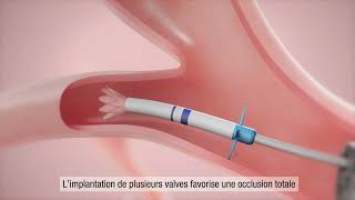 La valve endobronchique Zephyr® pour les personnes atteintes de BPCO et demphysème Français [upl. by Lenes]