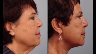 Advanced Facelift  Day by Day Actual Patient Recovery in Her Own Selfies [upl. by Kristine]