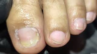 Toenail Ingrown Removal ang dami [upl. by Ahsiel]