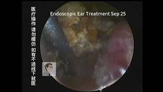 Postoperative cleaning of middle ear cholesteatoma 20230925 [upl. by Nogam]