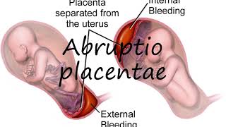 How to Pronounce Abruptio placentae [upl. by Eyahc]