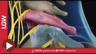 C7T1 ESI epidural steroid injection animated surgery recreation [upl. by Daphne]