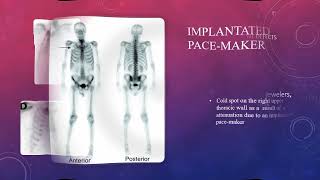 Artifacts in bone scintigraphy MCQs nuclearmedicineMCQ nuclearmedicine RSO frcr bonescan [upl. by Teage603]