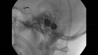 EMBOLIZATION OF A GIANT VERTEBRAL ARTERY ANEURYSMmp4 [upl. by Asiat]