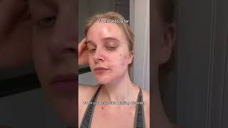 Picking your skin uncontrollably That has a name dermatillomania acne skincaretips explorepage [upl. by Celisse560]