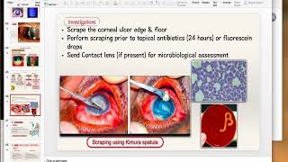 Bacterial Keratitis Part 2 [upl. by Nylevol]