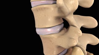 Back Pain Lumbar Disc Injury [upl. by Alenas]