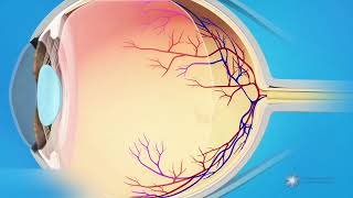 Membrane épirétinienne  diagnostic causes symptômes évolution et pronostic [upl. by Aisatna]