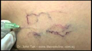 Injection Sclerotherapy [upl. by Karin]