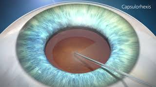 Cataract Surgery Animation [upl. by Good]