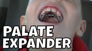 ANDREW GETS A PALATE EXPANDER ROOT CANAL UPDATE [upl. by Sheya]