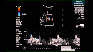 Renal Artery Doppler  Case Study [upl. by Raymonds230]