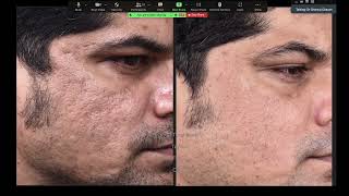 Combination Treatment of Acne Scars [upl. by Kelsy411]