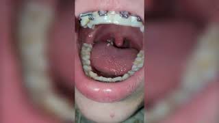 Deep Tonsil Stone Removal  Tonsil Stones [upl. by Sahcnip114]