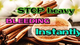 HOW TO STOP HEAVY MENSTRUAL BLEEDING INSTANTLY  HEAVY MENSTRUAL BLEEDING CAUSED BY PCOS FIBROIDS [upl. by Nirrep]