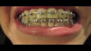 Braces Update  15 One molar elastic [upl. by Shore203]