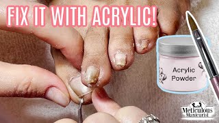 How to use Acrylic to Fix a Pincer Toenail Tutorial [upl. by Occer]