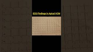 ECG Findings in Apical HCM cardiomyopathyhypertrophyhypertensionheartfailurepericarditisaorta [upl. by Bordy]